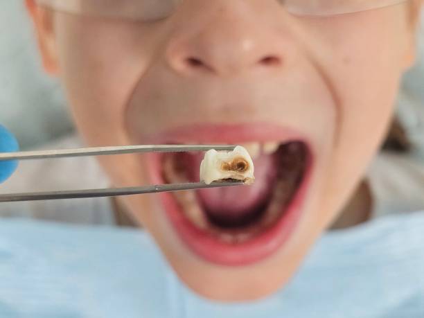 Best Emergency Tooth Extraction in Chandler, OK